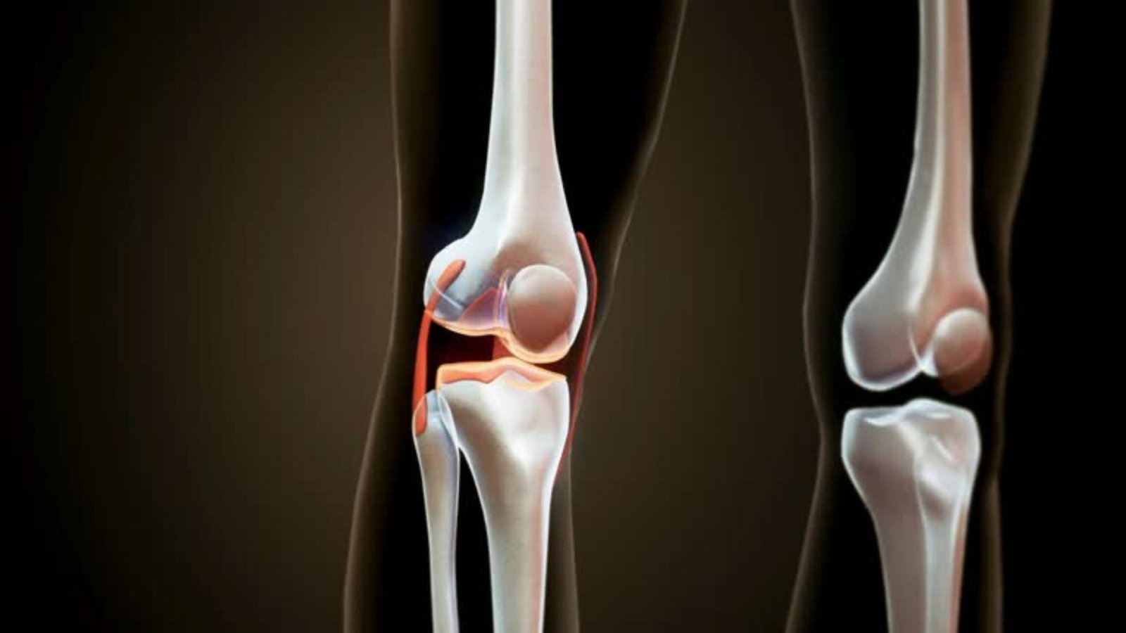 மூட்டுத் தேய்மானத்திற்கு ஸ்டான்போர்ட் பல்கலைக்கழகத்தின் புதிய தீர்வு!