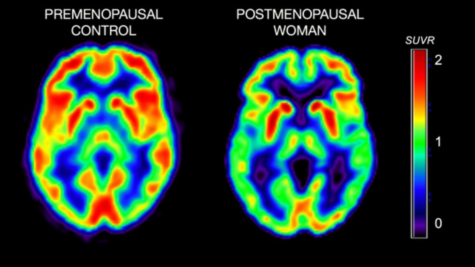 பெண்களும் அல்சைமர் நோயும்: மெனோபாஸ் கால மாற்றங்களே முக்கியக் காரணம்!